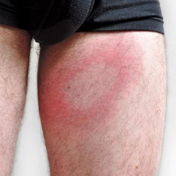 LMB Lotion Traitement naturel contre la maladie de Lyme à appliquer dès et sur la piqûre de tique - LMB Lotion - Labosp.com